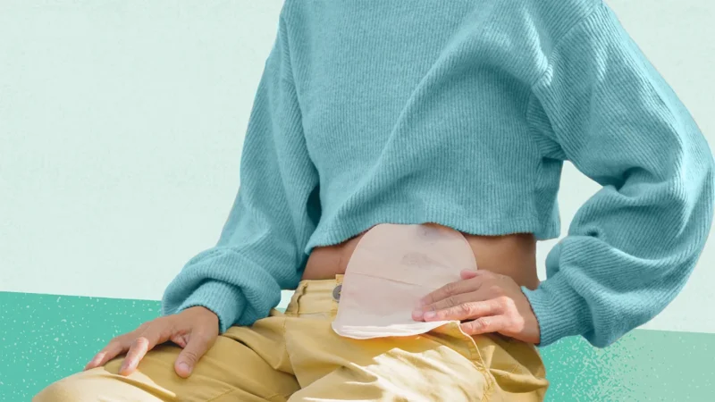 Livet med stomi: Tips og råd for å reise med stomi